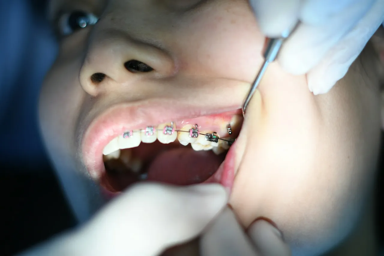 Aparat dentar fix pe dinți