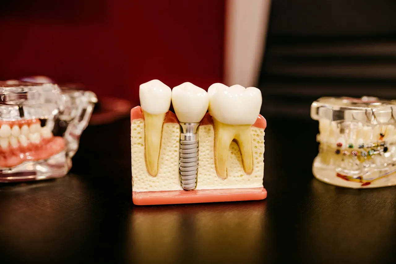 Model de implant dentar cu dinți