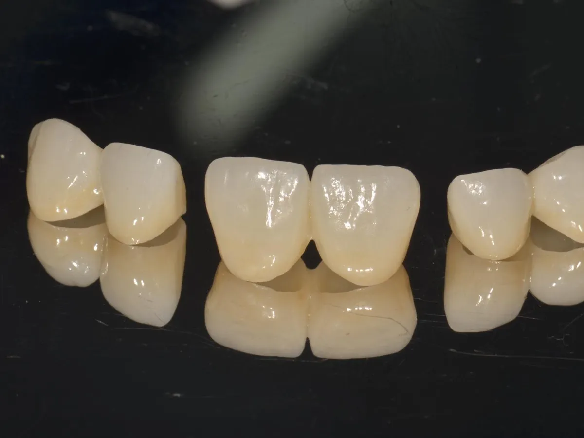 Coroane de zirconiu realizate pentru un pacient al clinicii DentaSpa