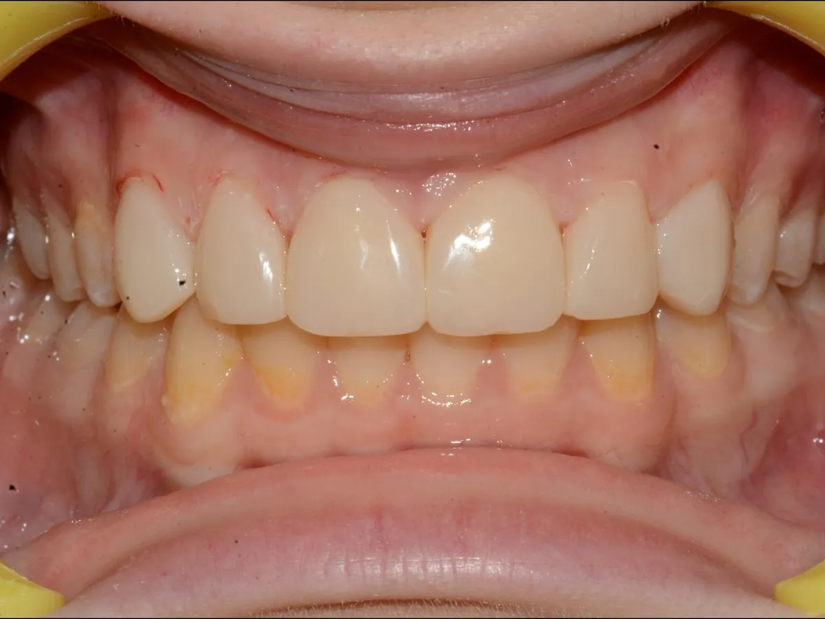Fațete dentare la DentaSpa Fălticeni, după: dinți uniformi ca formă și culoare, zâmbet natural