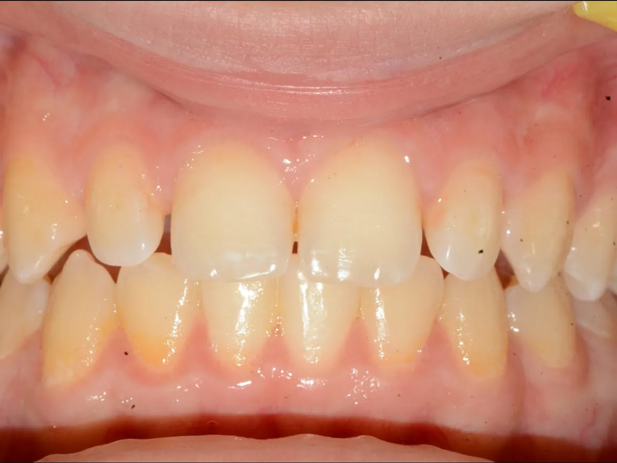Estetică dentară la DentaSpa Fălticeni, înainte: dinți gălbui, cu formă și lungime neuniforme