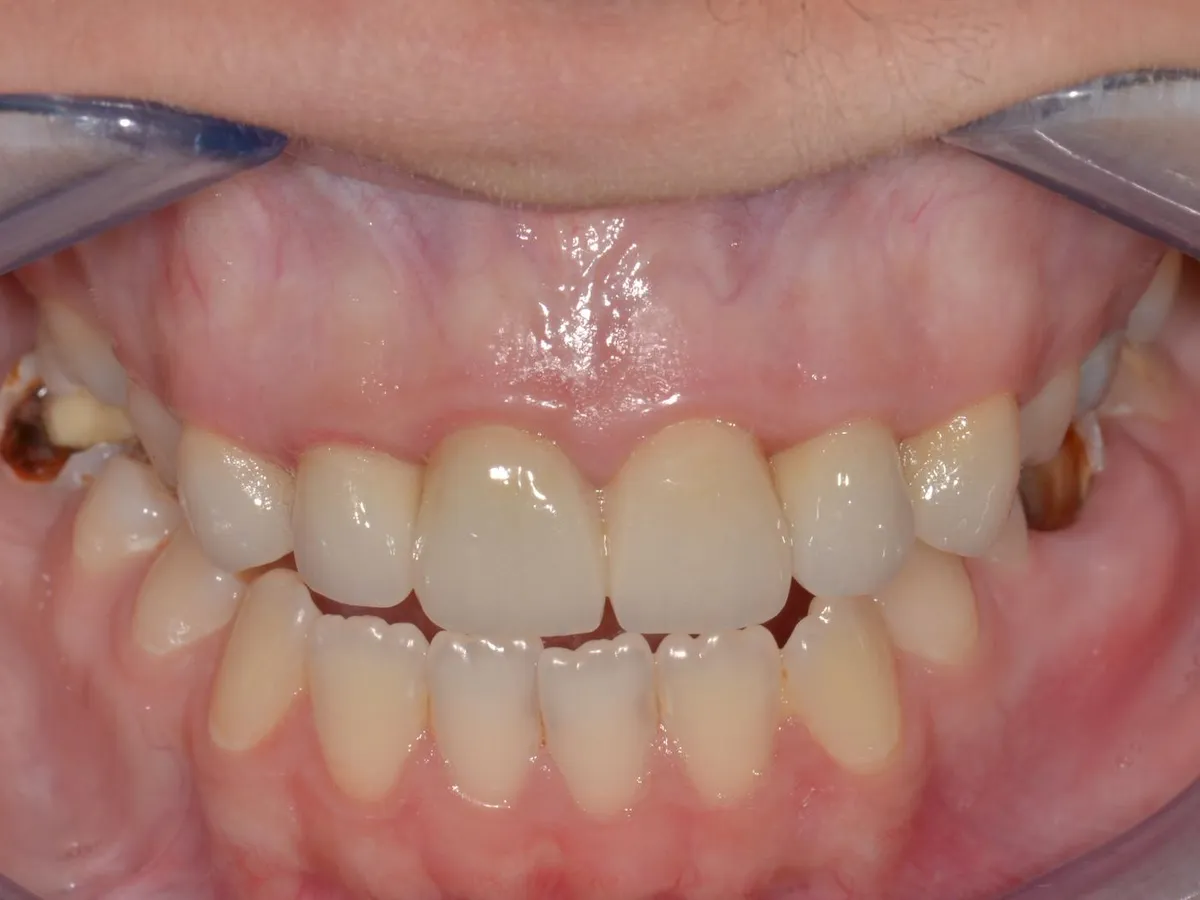 Coroane de zirconiu pe implant în Fălticeni, după tratament: dinți frontali refăcuți, aspect natural