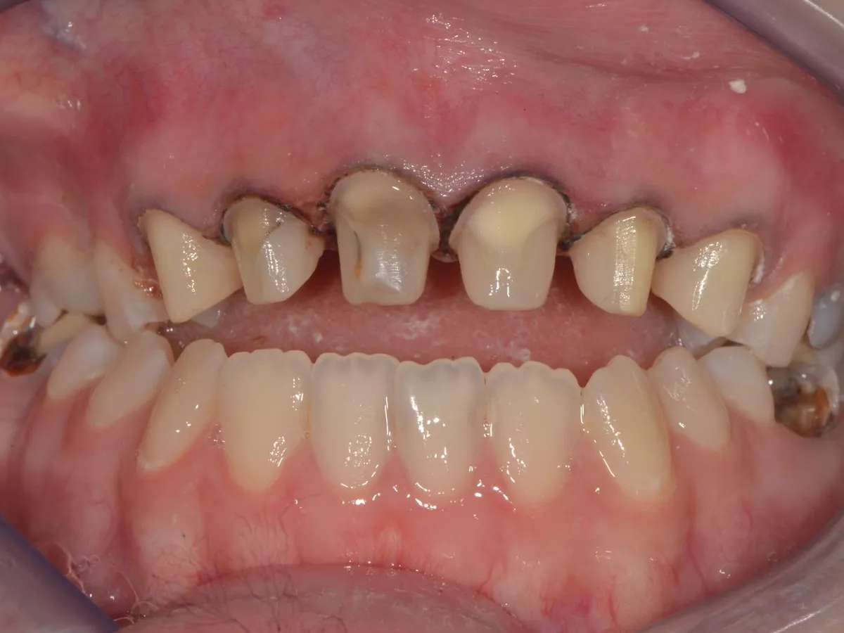 Implant dentar în Fălticeni, înainte de tratament: dinți frontali deteriorați și spații edentate
