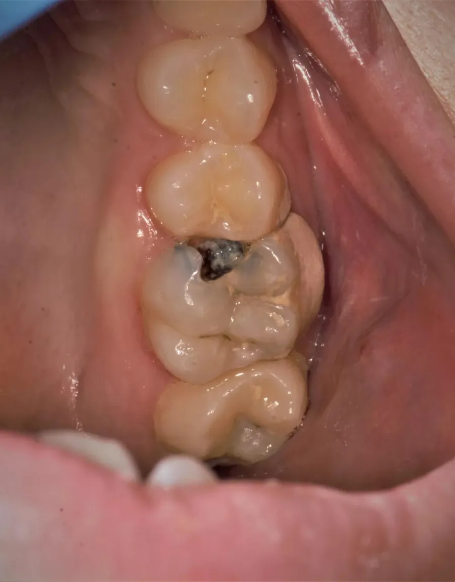 Restaurare sub microscop la DentaSpa Fălticeni, înainte: molar cu carie profundă