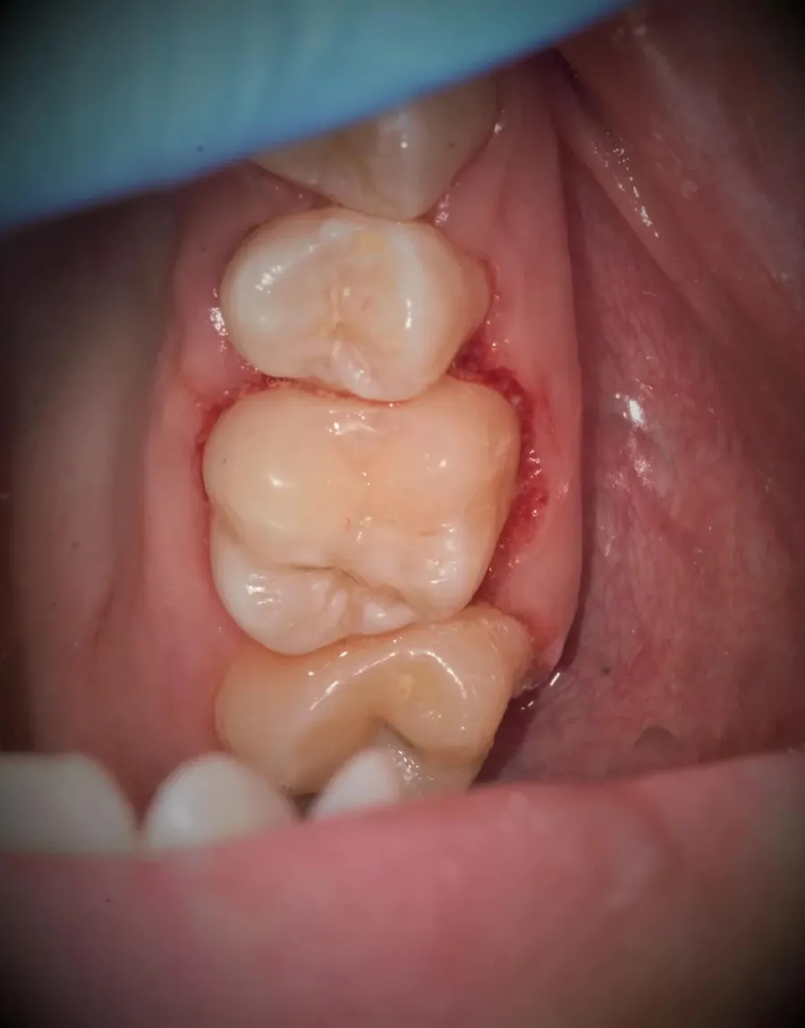 Restaurare dentară realizată sub microscop la DentaSpa Fălticeni