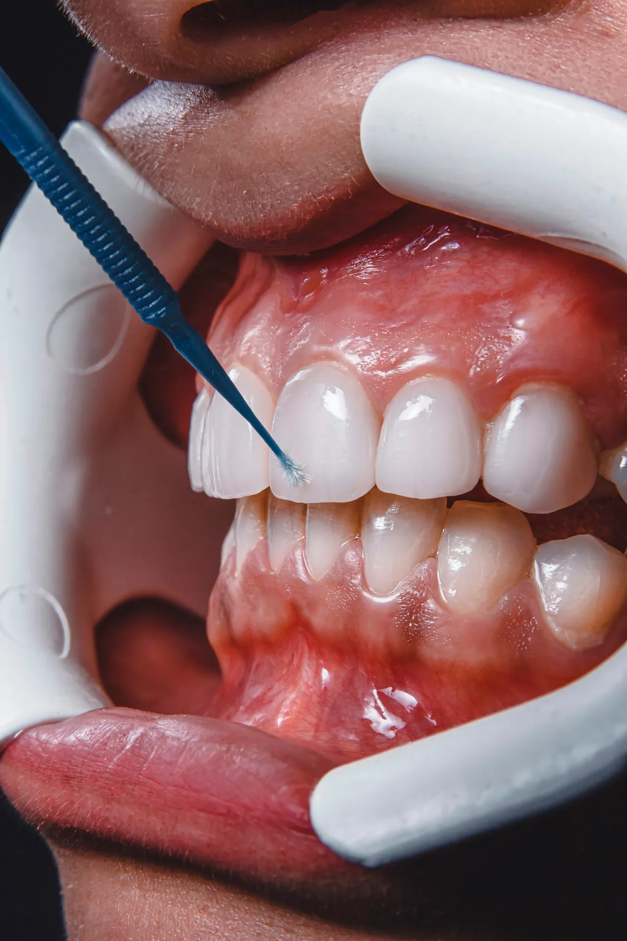 Tratamentul gingiilor la cabinet